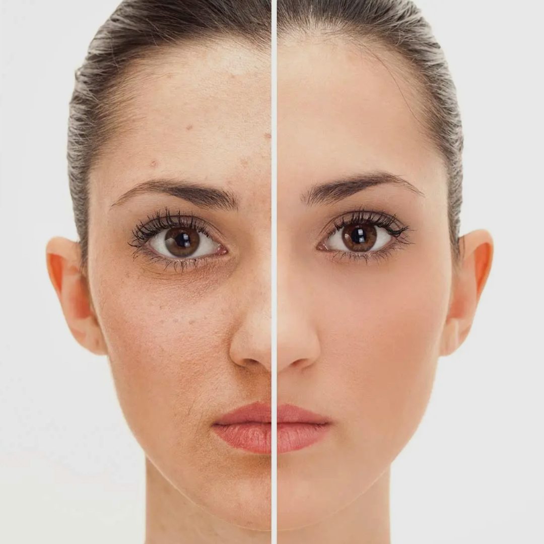 Avant et après utilisation du sérum concentré apaisant au β-glucane Magnolia Orchid (USA), montrant une peau plus lisse et apaisée.