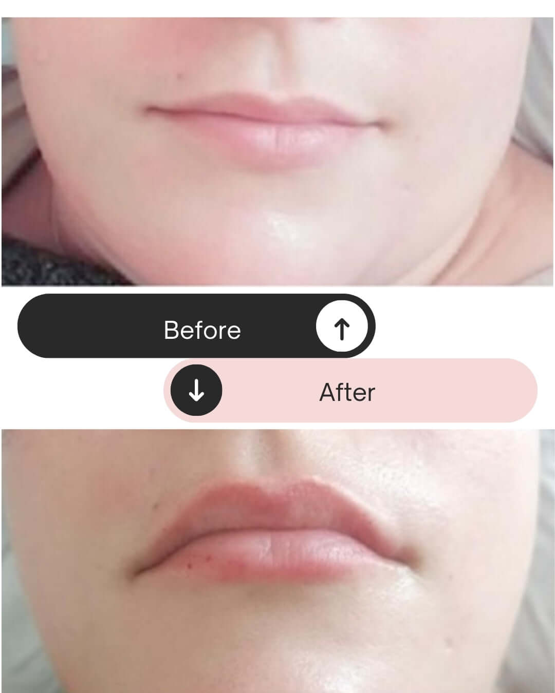 formation hydralips avec kit produits