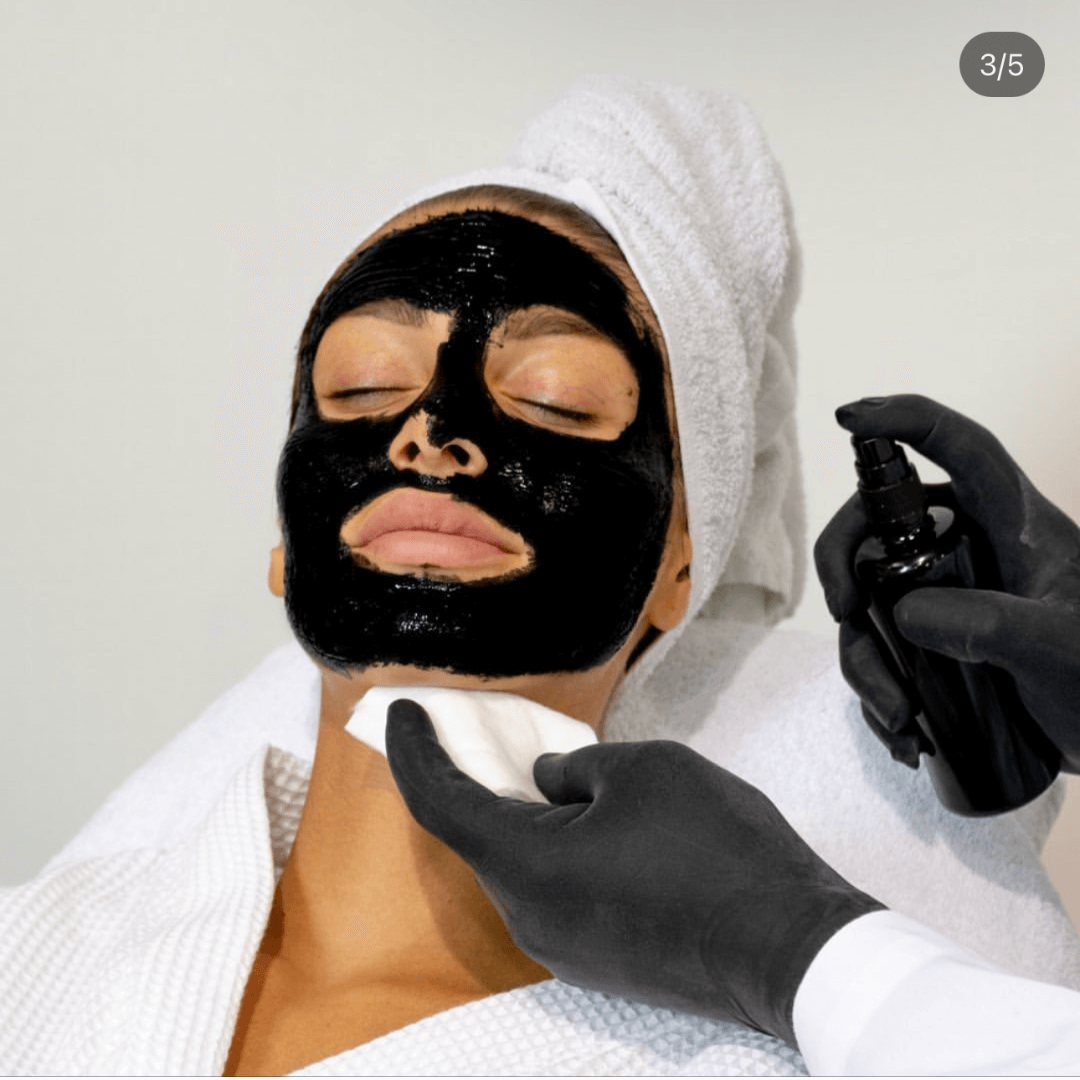 Kit Peeling V Carbon application on a client with black mask, showcasing the non-laser facial treatment process.