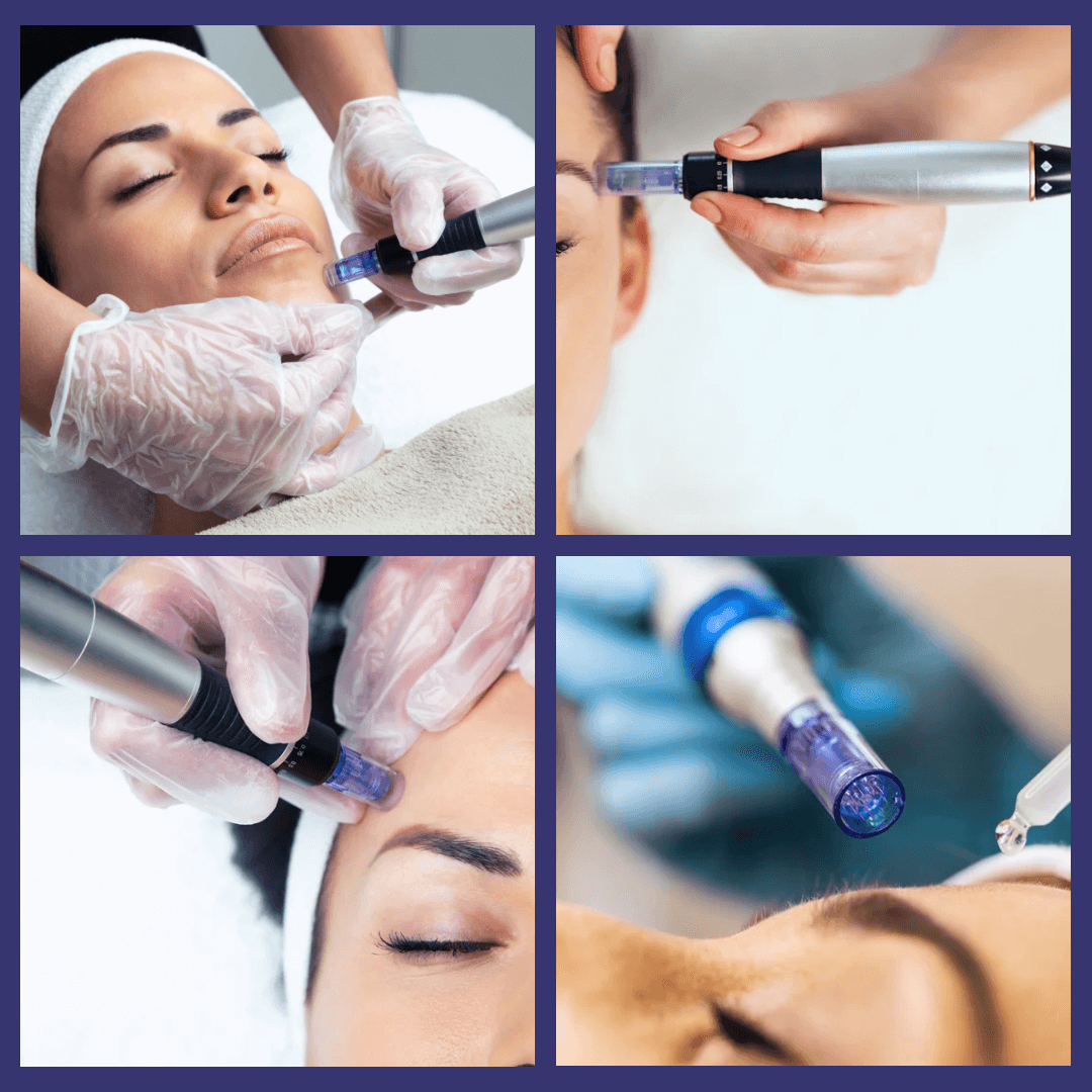 Techniques de microneedling illustrées en gros plan, soins esthétiques professionnels pour visage avec dermapen.